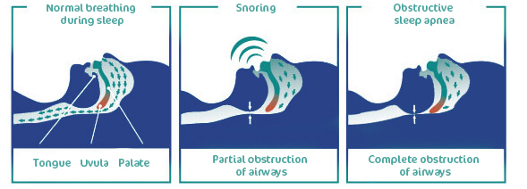 sleep apnea causes